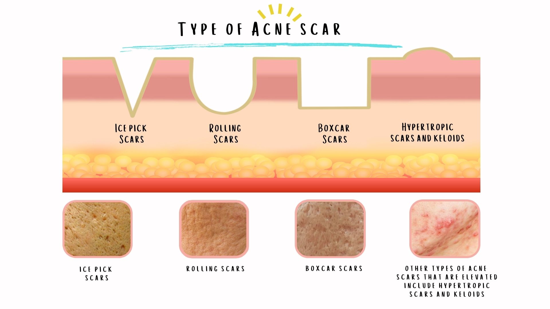 Types of Common Acne Scar