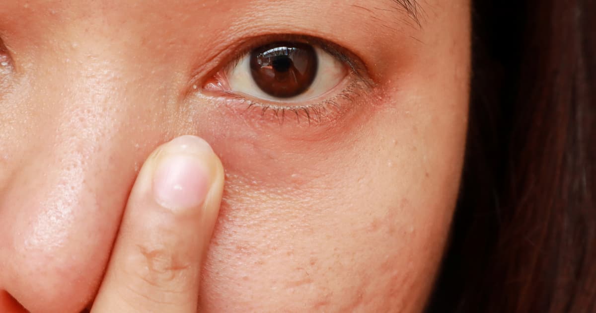 Dark circles under the eyes is a common thing especially as we age